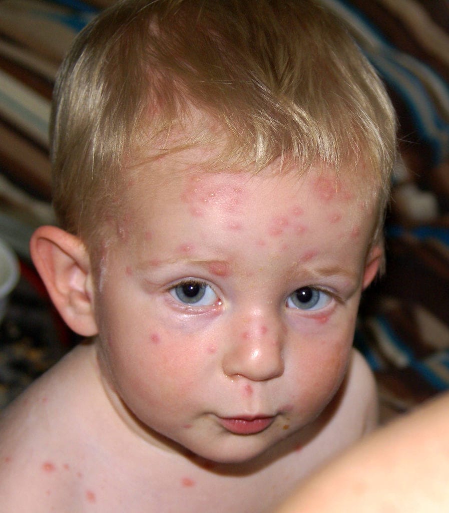 chickenpox in babies