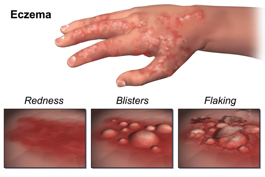 Baby Eczema Symptoms